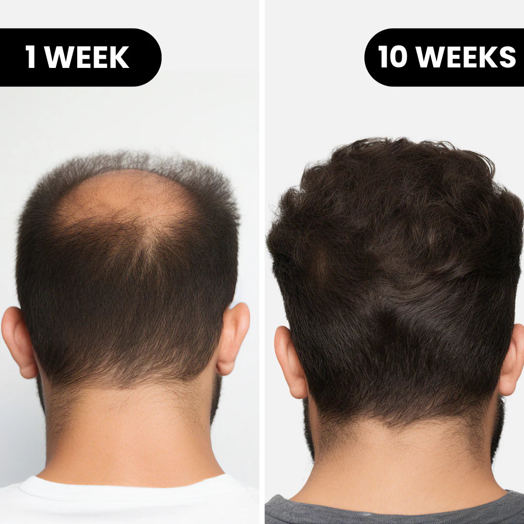 Renewal™ Hair Regrowth System