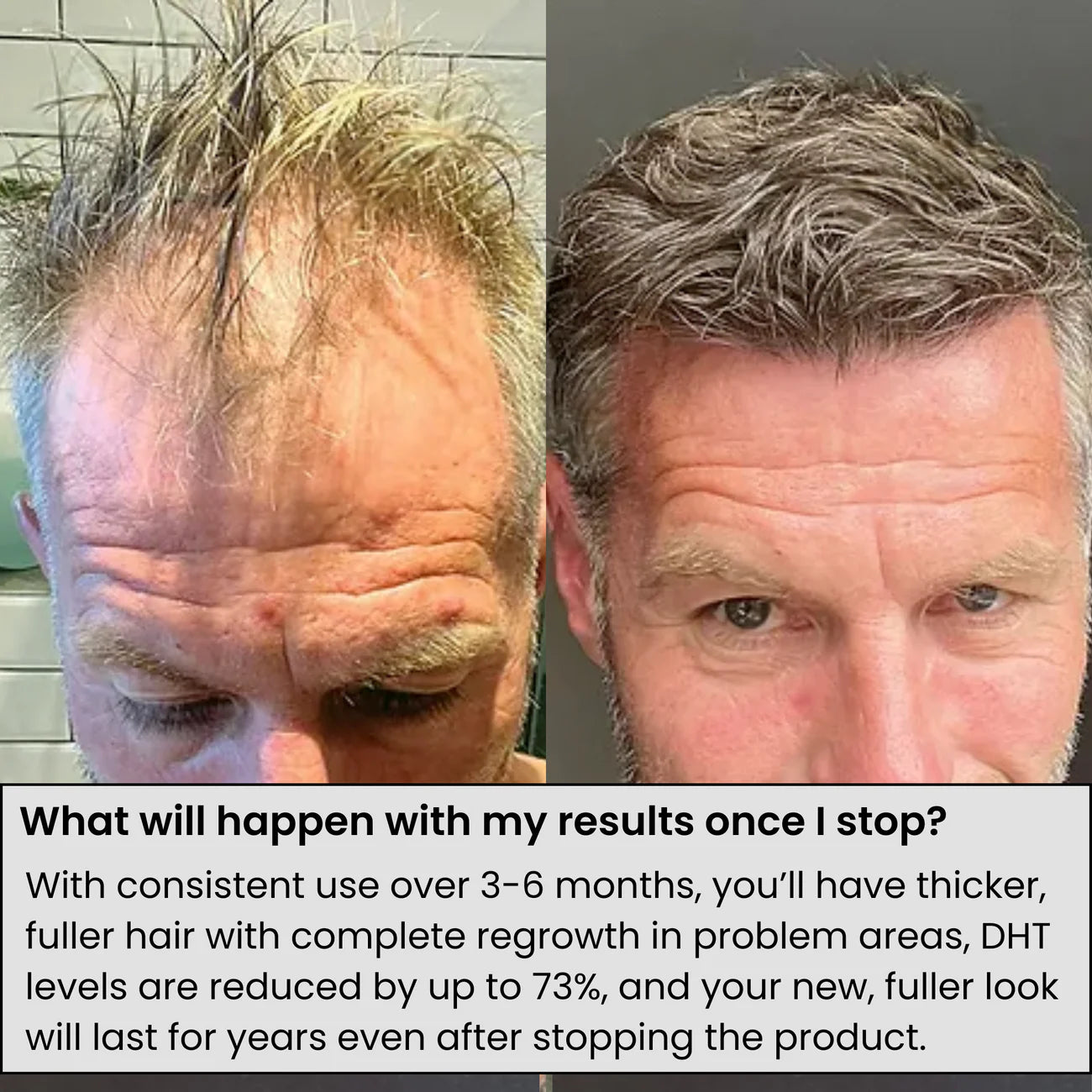 Renewal™ Hair Regrowth System